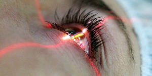 Проведение лазерной коррекции зрения: правила и этапы