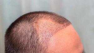 Процесс пересадки волос: этапы и рекомендации